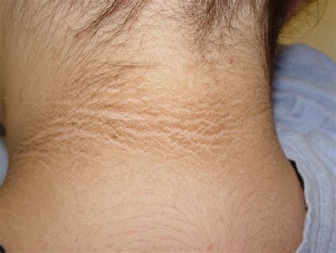 Acantosis nigricans, principalmente en DM2